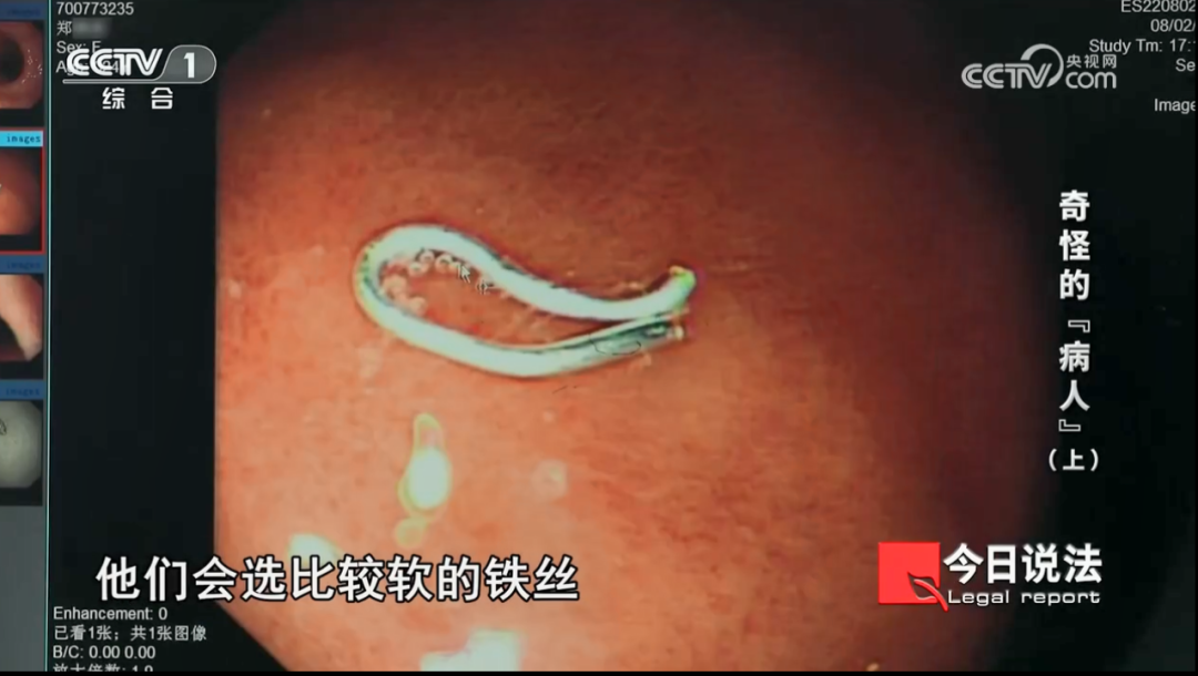 一周内2人在饭店吃到铁丝就诊！医生检查发现不对劲……